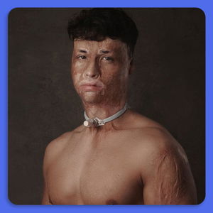 Als 6-jarig jongetje verbrand door kerstboomverlichting