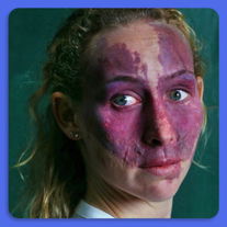 Wijnvlek, littekens, blind worden en uiterlijke acceptatie