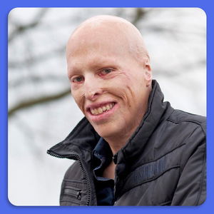 Voor 67% VERBRAND bij de brand in VOLENDAM